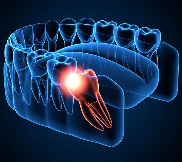 New York Wisdom Teeth Extraction